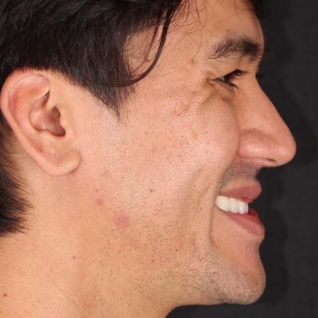 Antes do tratamento — Cirurgia Ortognática