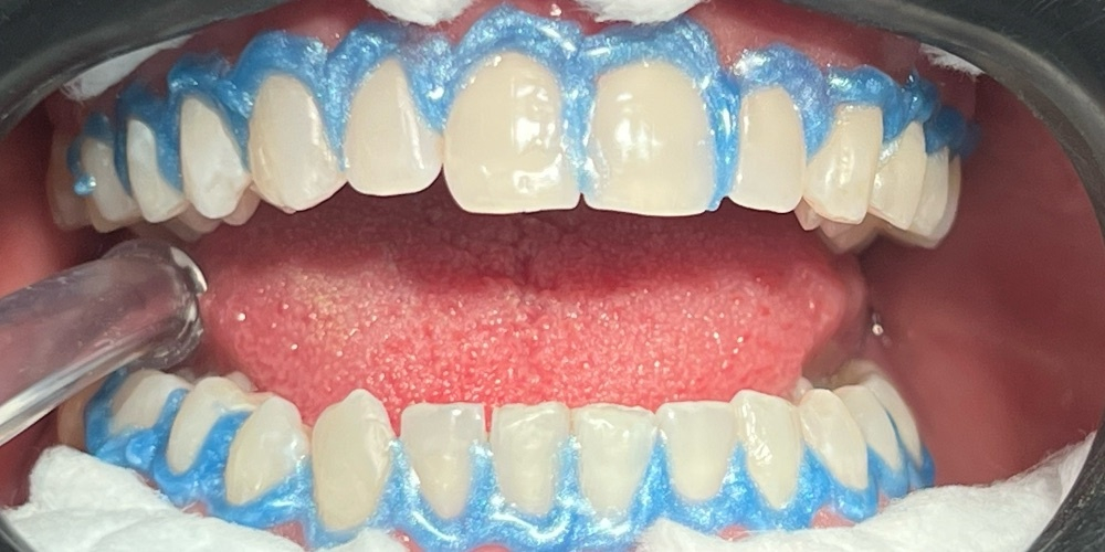 Antes do tratamento — Clareamento Dental