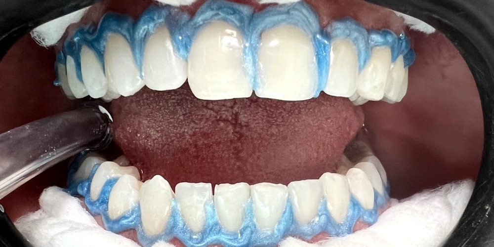 Depois do tratamento — Clareamento Dental