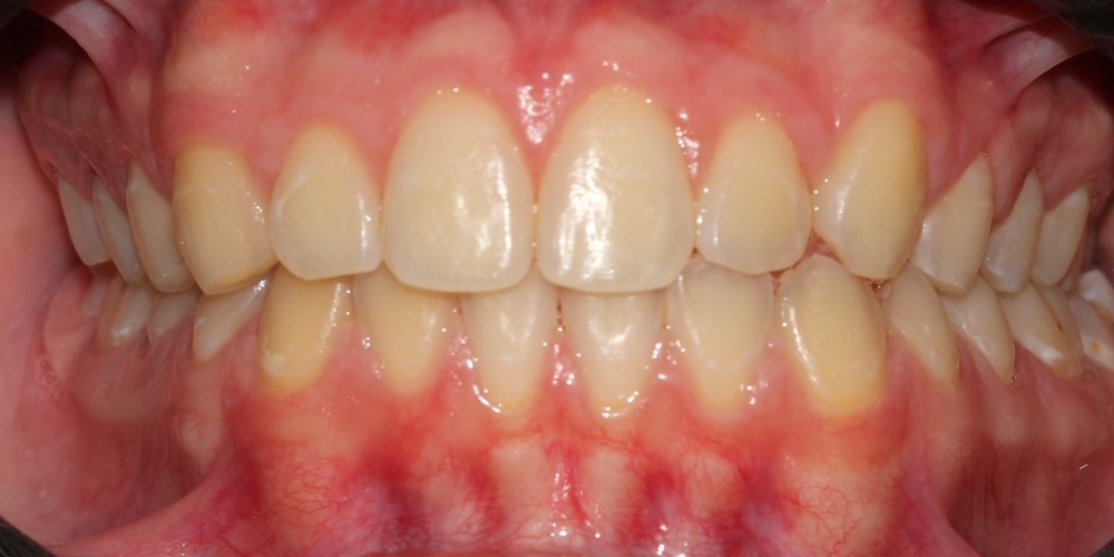 Antes do tratamento — Clareamento Dental