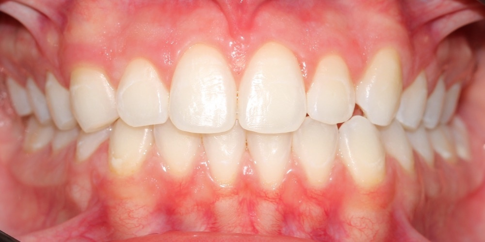 Depois do tratamento — Clareamento Dental