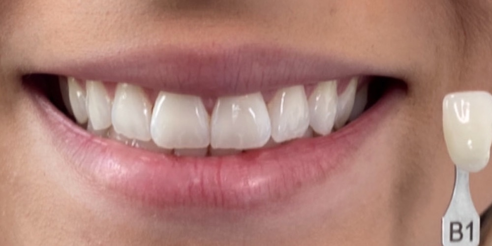 Antes do tratamento — Clareamento Dental