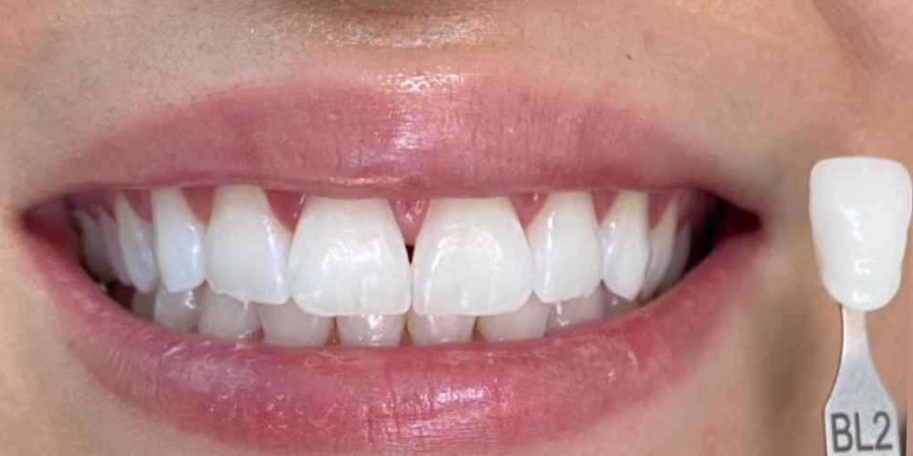 Depois do tratamento — Clareamento Dental