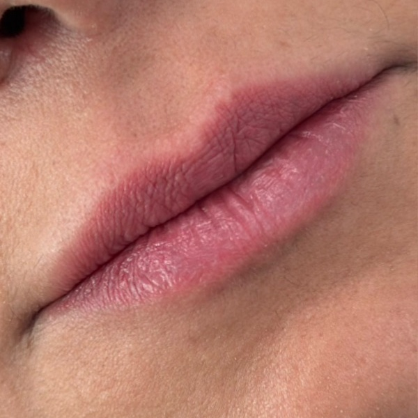 Antes do tratamento — Harmonização Orofacial