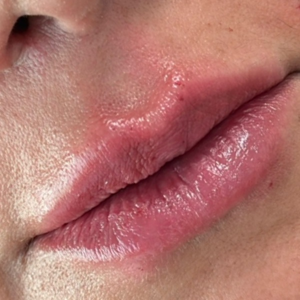 Depois do tratamento — Harmonização Orofacial