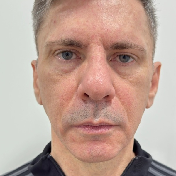 Antes do tratamento — Harmonização Orofacial