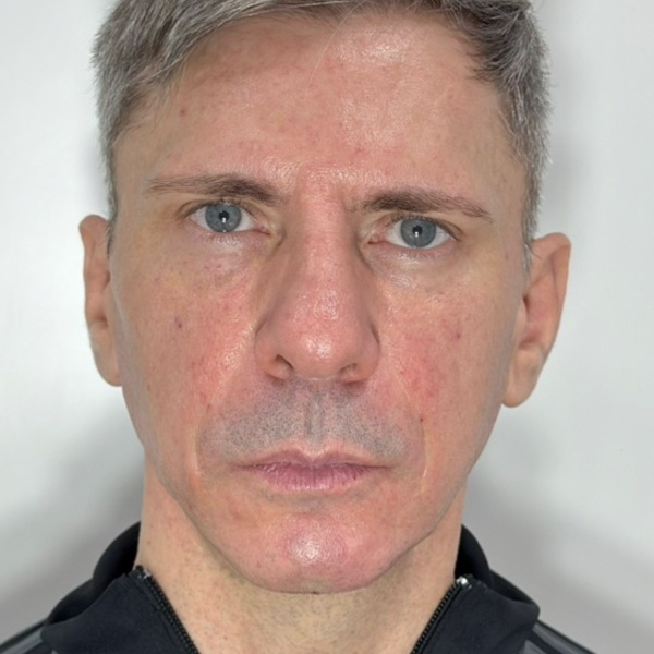Depois do tratamento — Harmonização Orofacial