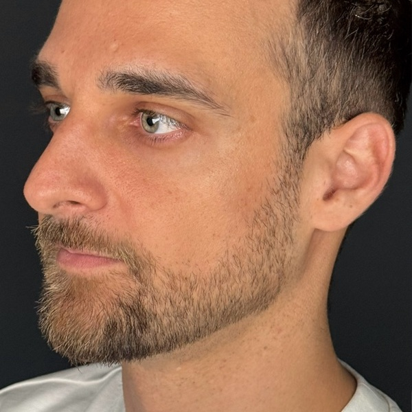 Antes do tratamento — Harmonização Orofacial
