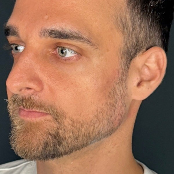 Depois do tratamento — Harmonização Orofacial