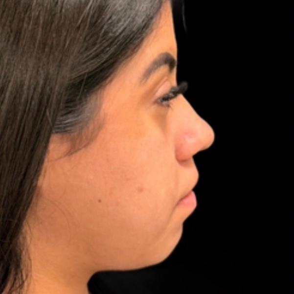 Antes do tratamento — Harmonização Orofacial