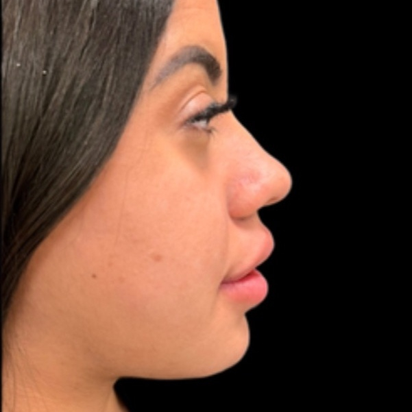 Depois do tratamento — Harmonização Orofacial