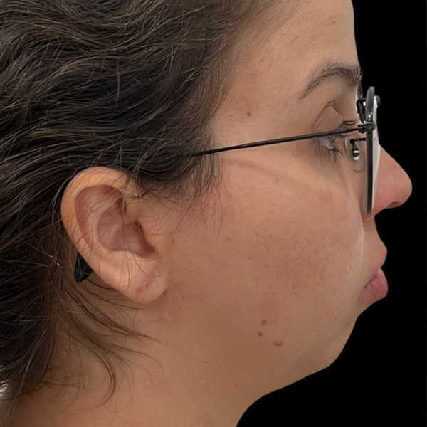 Antes do tratamento — Harmonização Orofacial