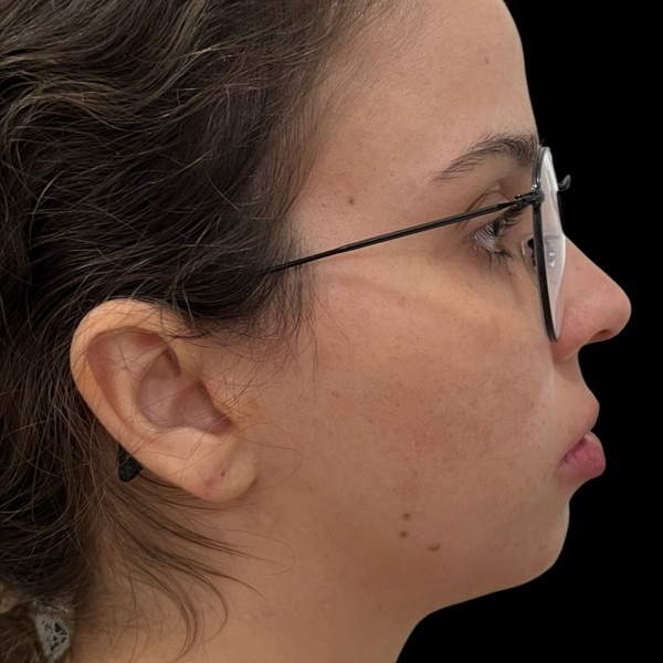 Depois do tratamento — Harmonização Orofacial