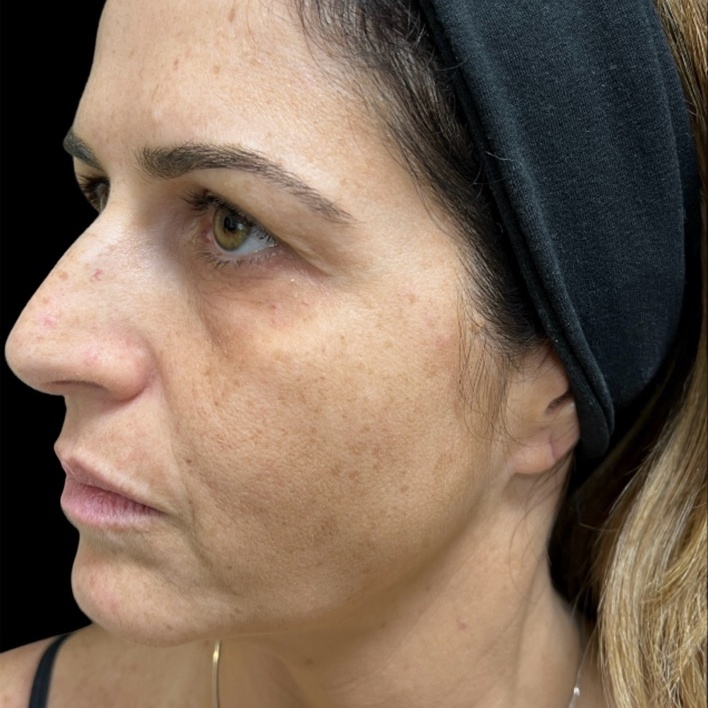 Antes do tratamento — Harmonização Orofacial