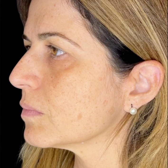 Depois do tratamento — Harmonização Orofacial