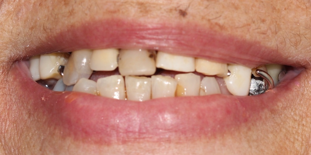 Antes do tratamento — Implantes Dentários