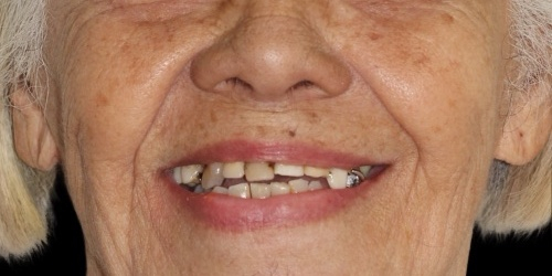 Antes do tratamento — Implantes Dentários
