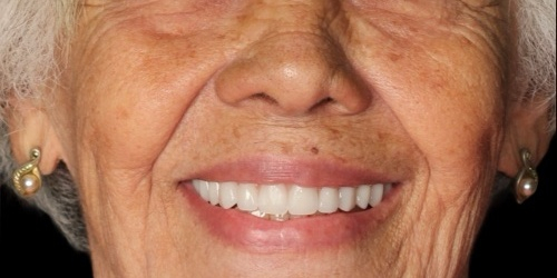 Depois do tratamento — Implantes Dentários