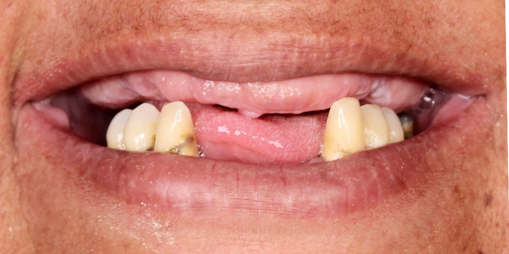 Antes do tratamento — Implantes Dentários