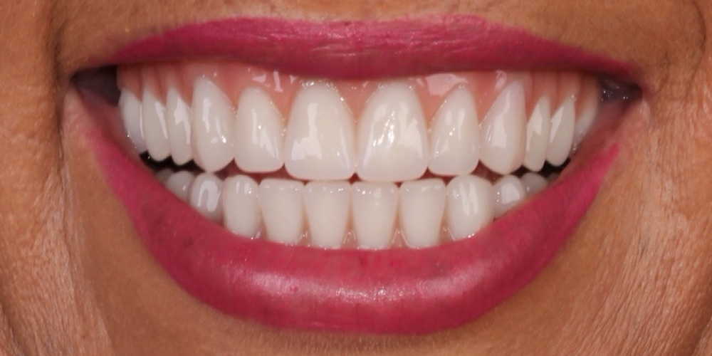 Depois do tratamento — Implantes Dentários