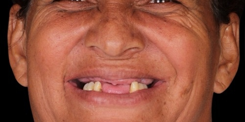 Antes do tratamento — Implantes Dentários