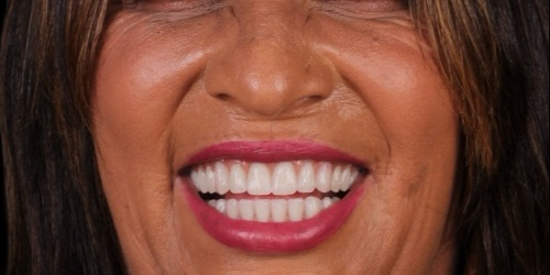 Depois do tratamento — Implantes Dentários