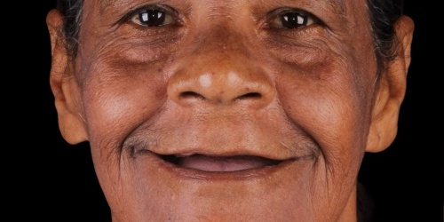 Antes do tratamento — Implantes Dentários