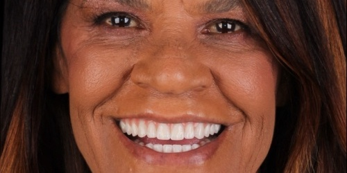Depois do tratamento — Implantes Dentários