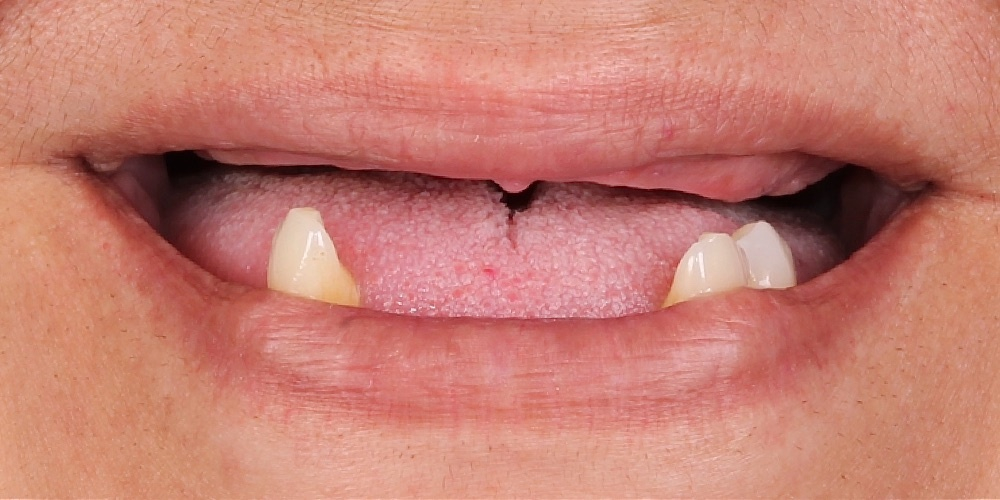 Antes do tratamento — Implantes Dentários