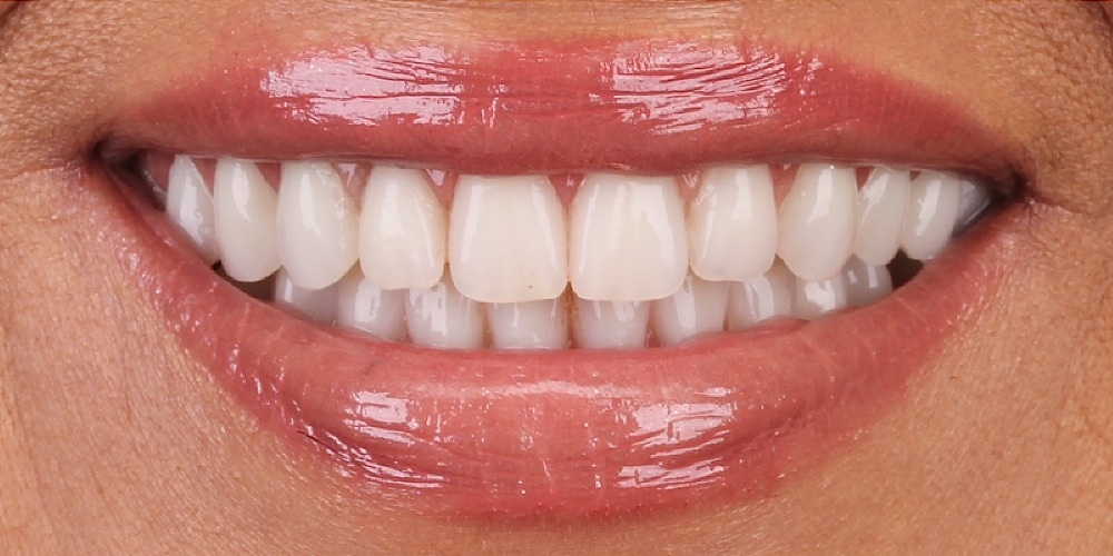 Depois do tratamento — Implantes Dentários