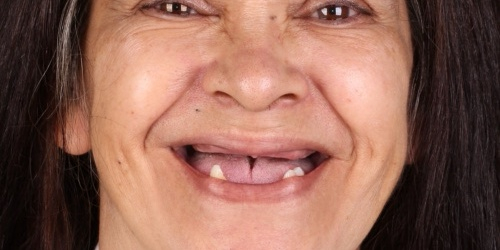 Antes do tratamento — Implantes Dentários