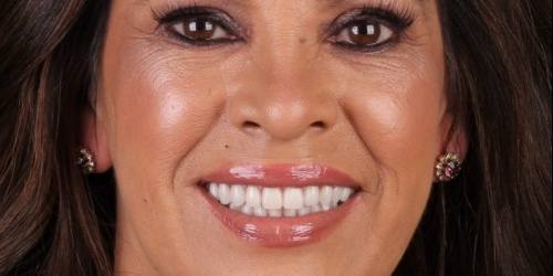 Depois do tratamento — Implantes Dentários