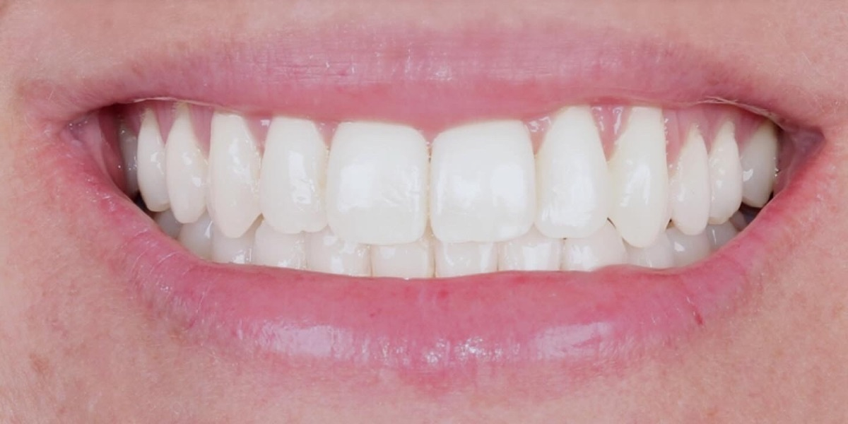 Depois do tratamento — Invisalign
