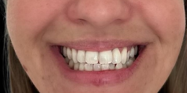 Antes do tratamento — Invisalign