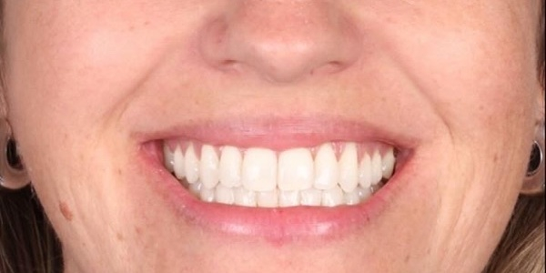 Depois do tratamento — Invisalign