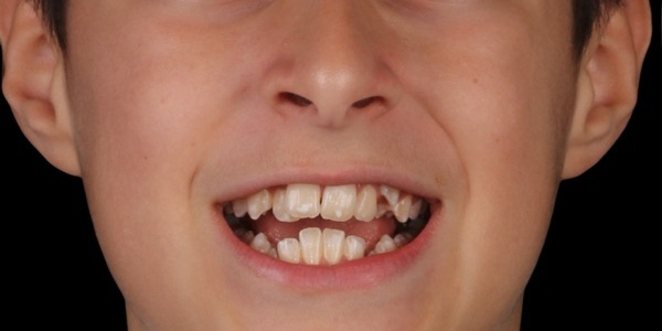 Antes do tratamento — Invisalign