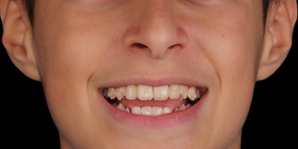 Depois do tratamento — Invisalign