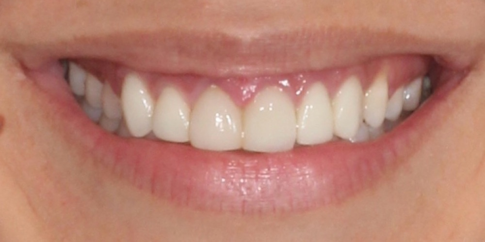 Antes do tratamento — Lentes de Porcelana