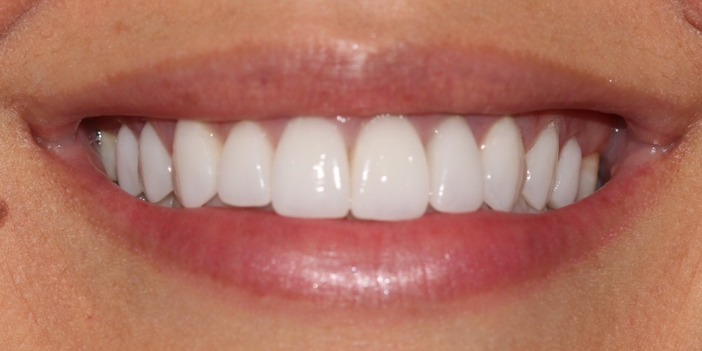 Depois do tratamento — Lentes de Porcelana
