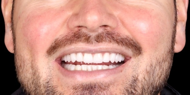 Depois do tratamento — Lentes de Porcelana