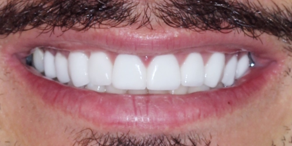 Antes do tratamento — Lentes de Porcelana