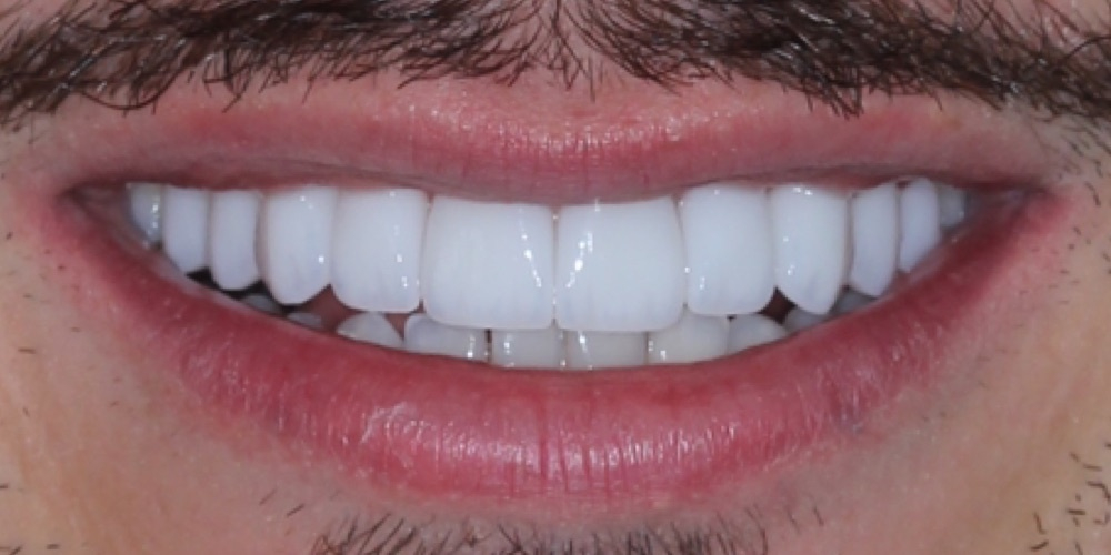 Depois do tratamento — Lentes de Porcelana