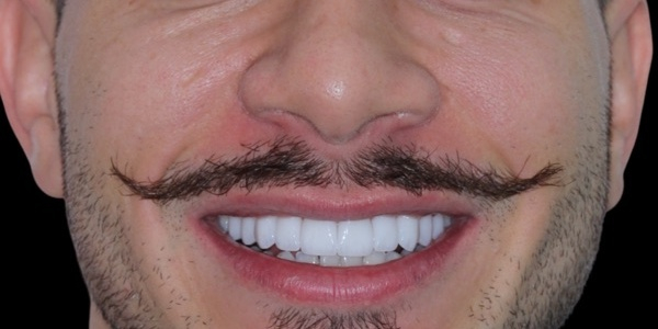 Depois do tratamento — Lentes de Porcelana