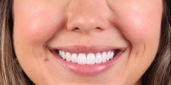 Depois do tratamento — Lentes de Porcelana