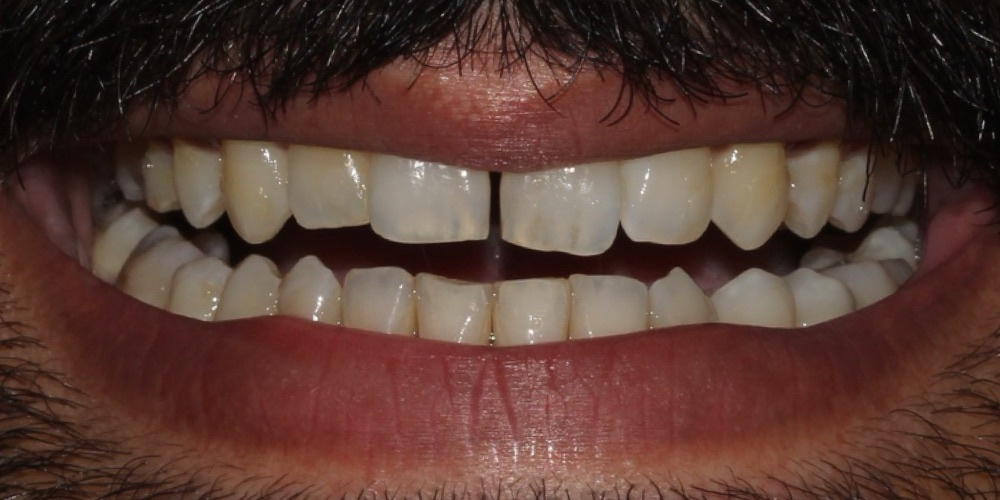 Antes do tratamento — Lentes de Porcelana