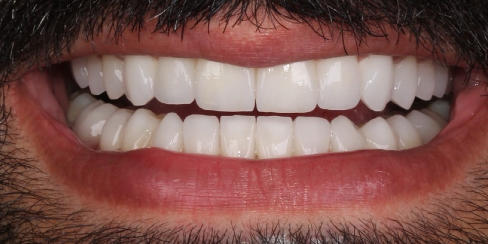 Depois do tratamento — Lentes de Porcelana
