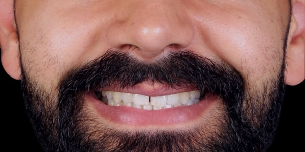 Antes do tratamento — Lentes de Porcelana