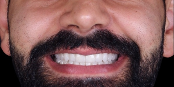 Depois do tratamento — Lentes de Porcelana