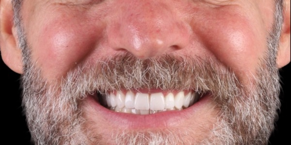 Depois do tratamento — Lentes de Porcelana