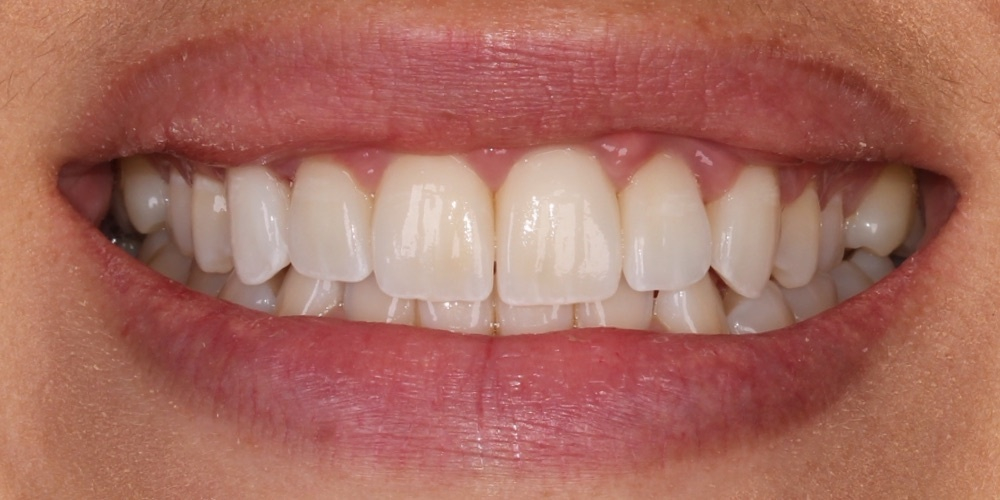 Antes do tratamento — Lentes de Porcelana